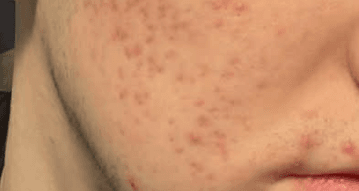 Après 2 traitements